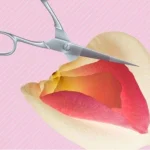 همه‌چیز درباره عمل مجدد یا ترمیم لابیاپلاستی