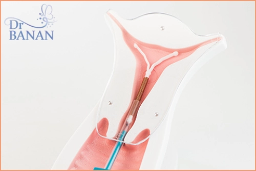 (IUD)