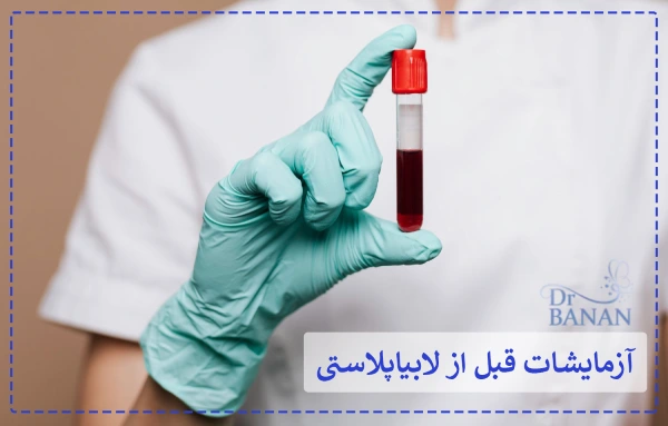 آزمایشات قبل از لابیاپلاستی